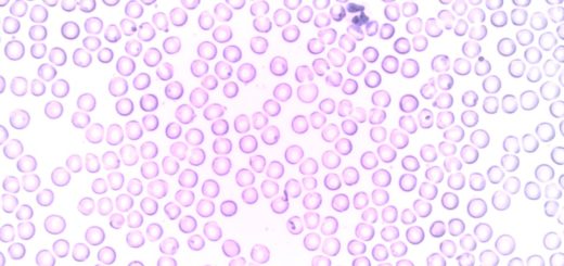 leucemia linfoblastica