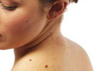 melanoma