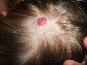 emangioma