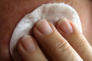 dermatite atopica