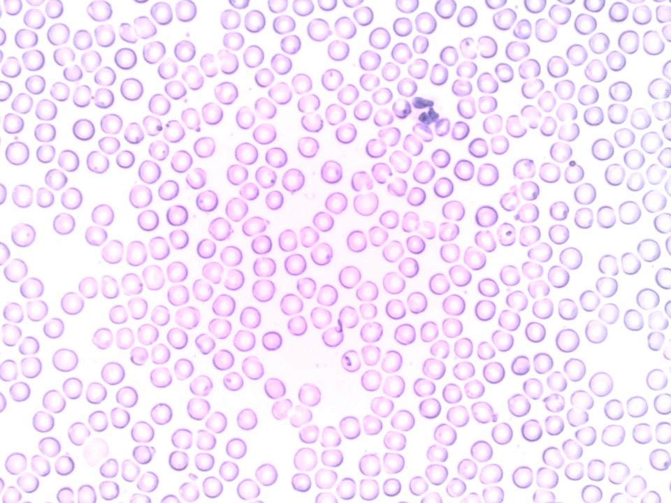 leucemia linfoblastica